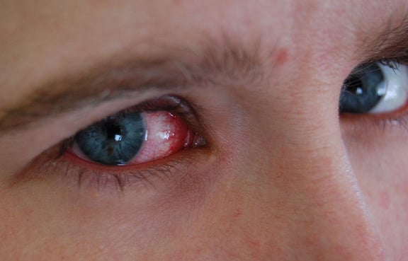 How to prevent pinkeye